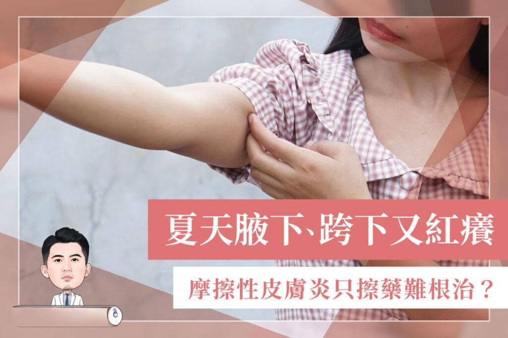 夏天腋下、跨下又紅癢！摩擦性皮膚炎只擦藥難根治？皮膚科醫師來為您解答！