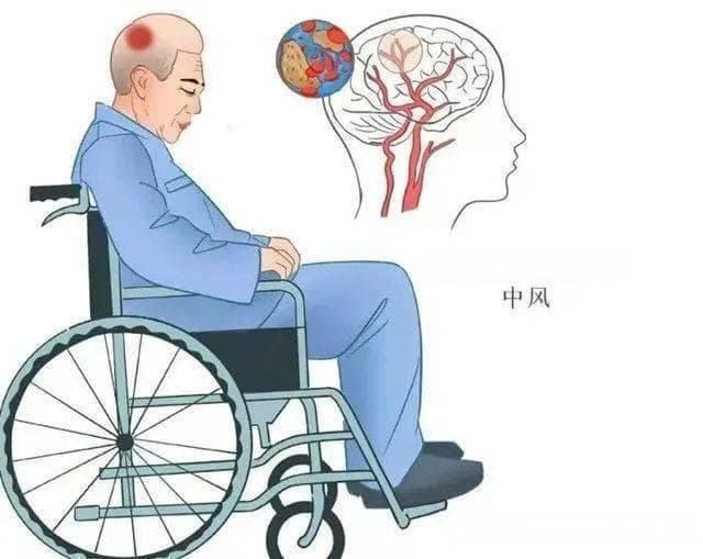 干细胞治疗脑出血后遗症，不同类型干细胞的疗效分析