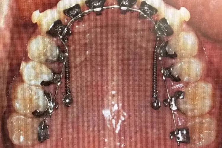 戴隐形牙套对牙齿有损害吗