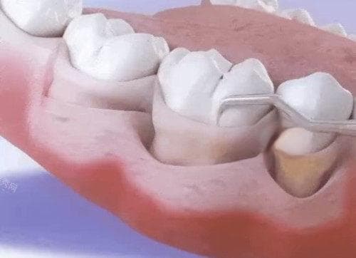 什么情况下需要做牙周治疗？牙周炎重度、牙周囊肿、牙周脓肿等都要做牙周治疗！