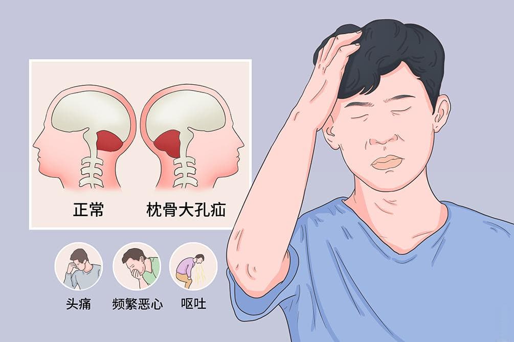 枕骨大孔疝