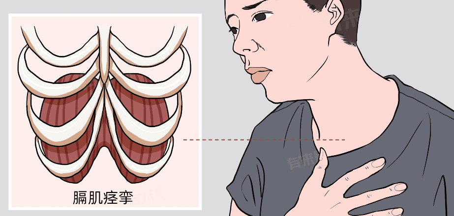 膈肌痉挛怎么办？三种实用治疗方法帮你摆脱频繁打嗝困扰