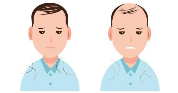 “脱发救星”：非那雄胺如何拯救男性型脱发