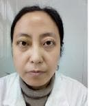红斑狼疮患者为何需要定期尿检？专家解读狼疮性肾炎的预防与监测