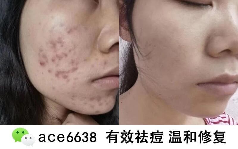 嘴边长痘痘用什么药膏 嘴边长痘痘怎么消除