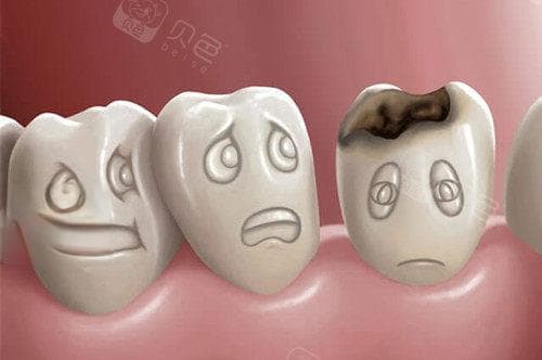 两个牙的牙缝中间蛀了怎么办？邻面龋的三种程度及治疗方案