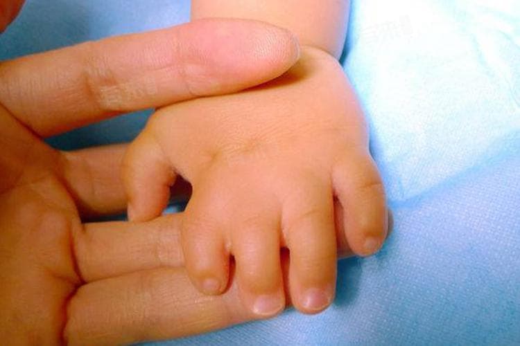 D型短指症：病因、症状与治疗方法全解析