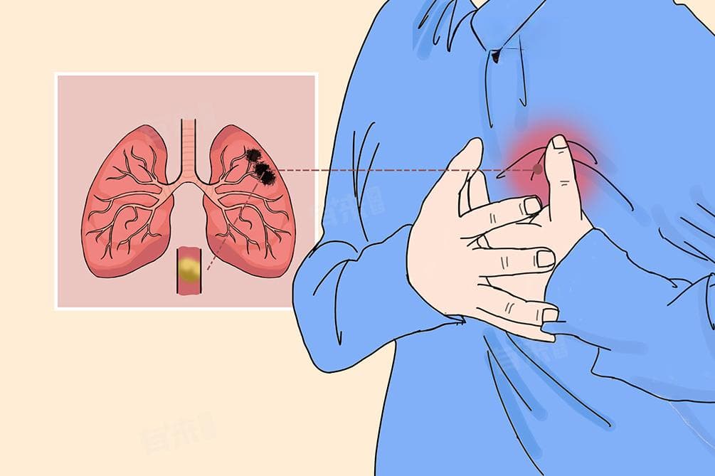 肺积液：病因、症状与预防全解析