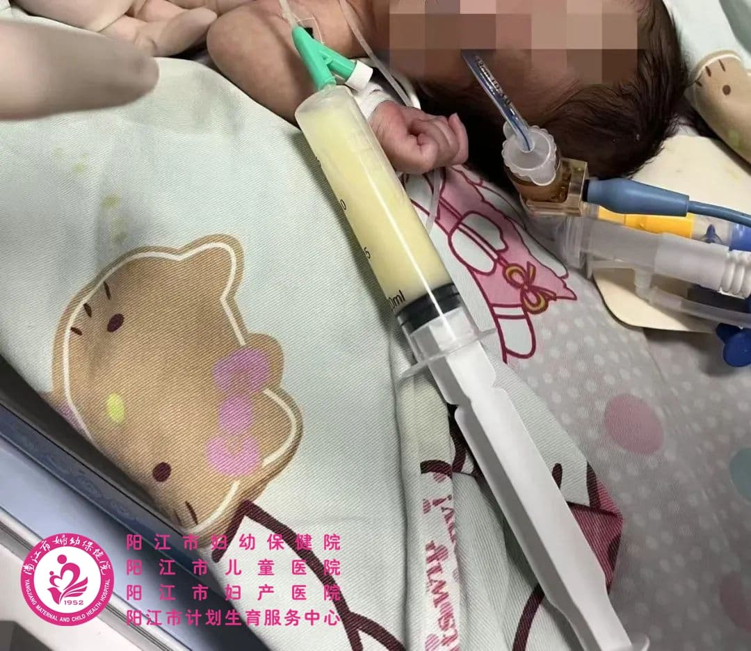 早产宝宝危在旦夕！胸腔内抽出100毫升乳白色液体，胸腔穿刺术为其带来生机~