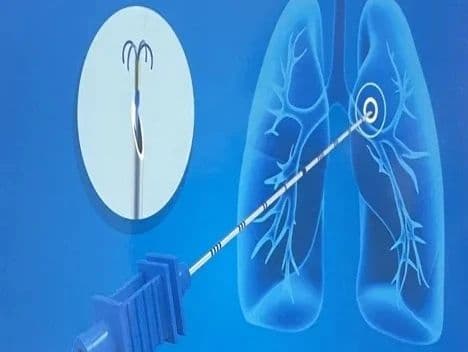 多学科协作！CT引导下经皮肺穿刺精准定位肺结节