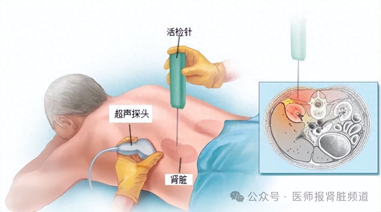 熊飞教授：肾脏疾病诊断的“金指标”——肾穿刺活检术知多少？| 世界肾脏日