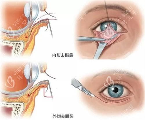 外切眼袋的疤痕多久能看不出来？形成及改善过程+促进修复的妙招一文奉上