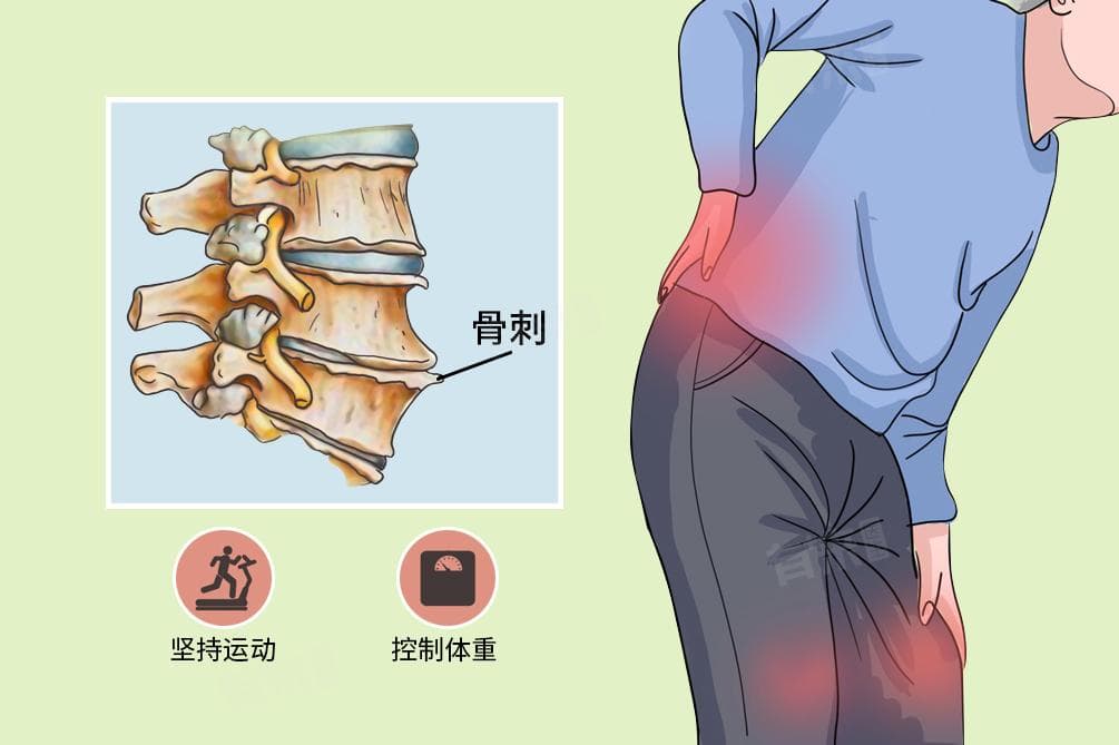 骨刺增生怎么治疗能根除