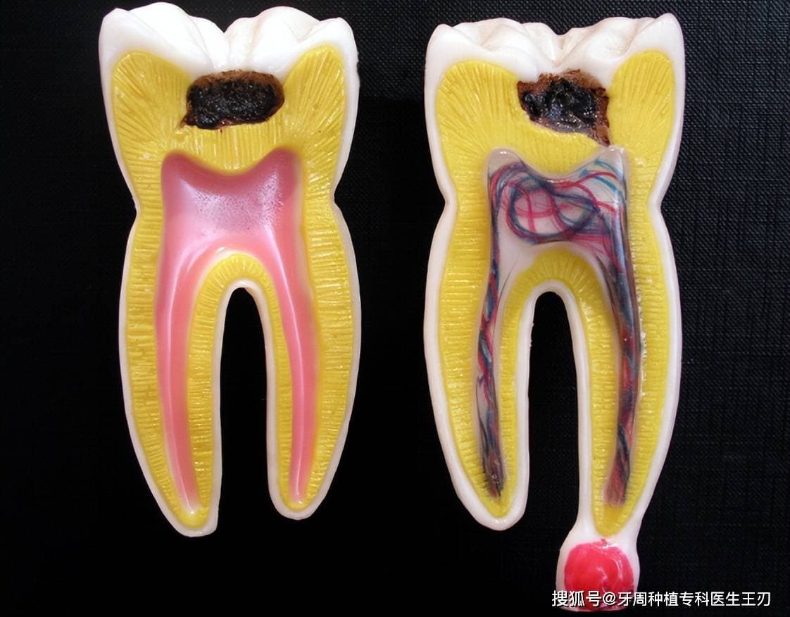 牙疼吃抗生素有用吗
