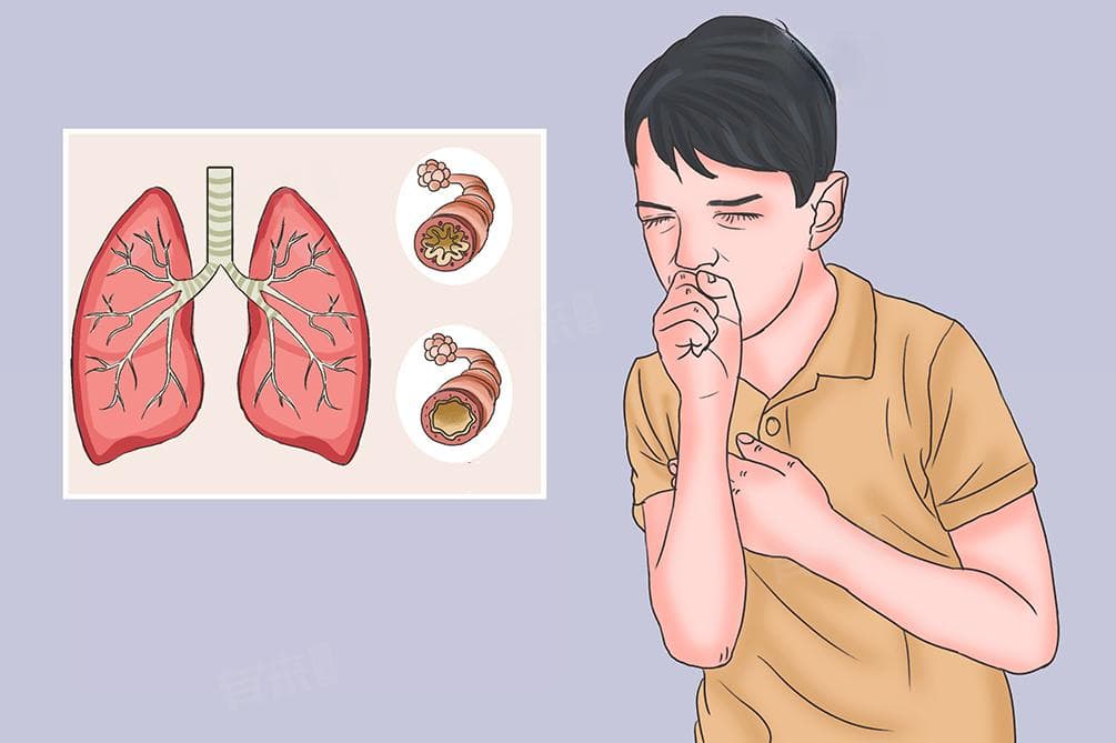 过敏性哮喘怎样治疗