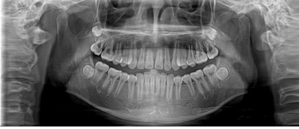 数字化口腔CBCT、牙片机、口腔全景机的区别