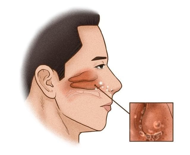 过敏性鼻炎四大症状、四种疗法，一文读懂防治要点