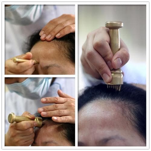 中医特色针法——太极杵针