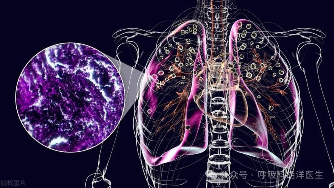 肺癌到底有没有传染性？一家三口都查出肺结节，原因令人深思