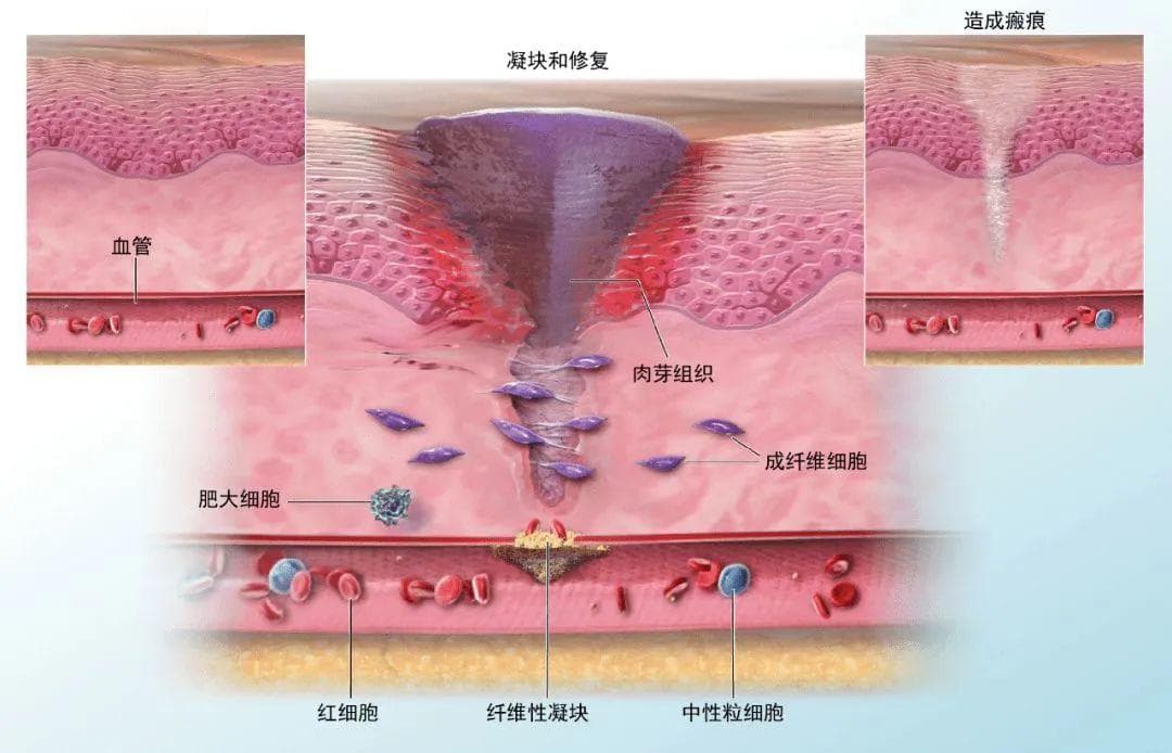 瘢痕的症状：红斑与增厚