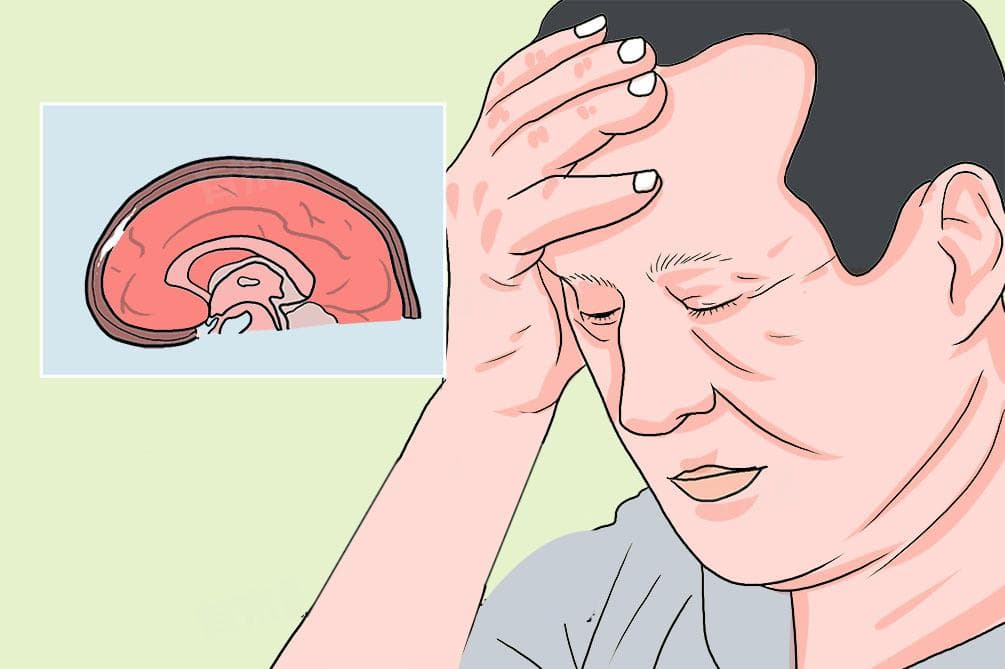 硬膜下积液原因