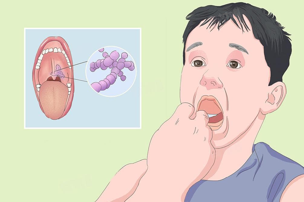 小孩子咽炎的治疗方法和预防措施