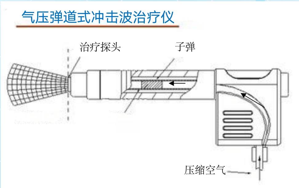 “非侵入性体外冲击波治疗”治疗时间短，见效快！