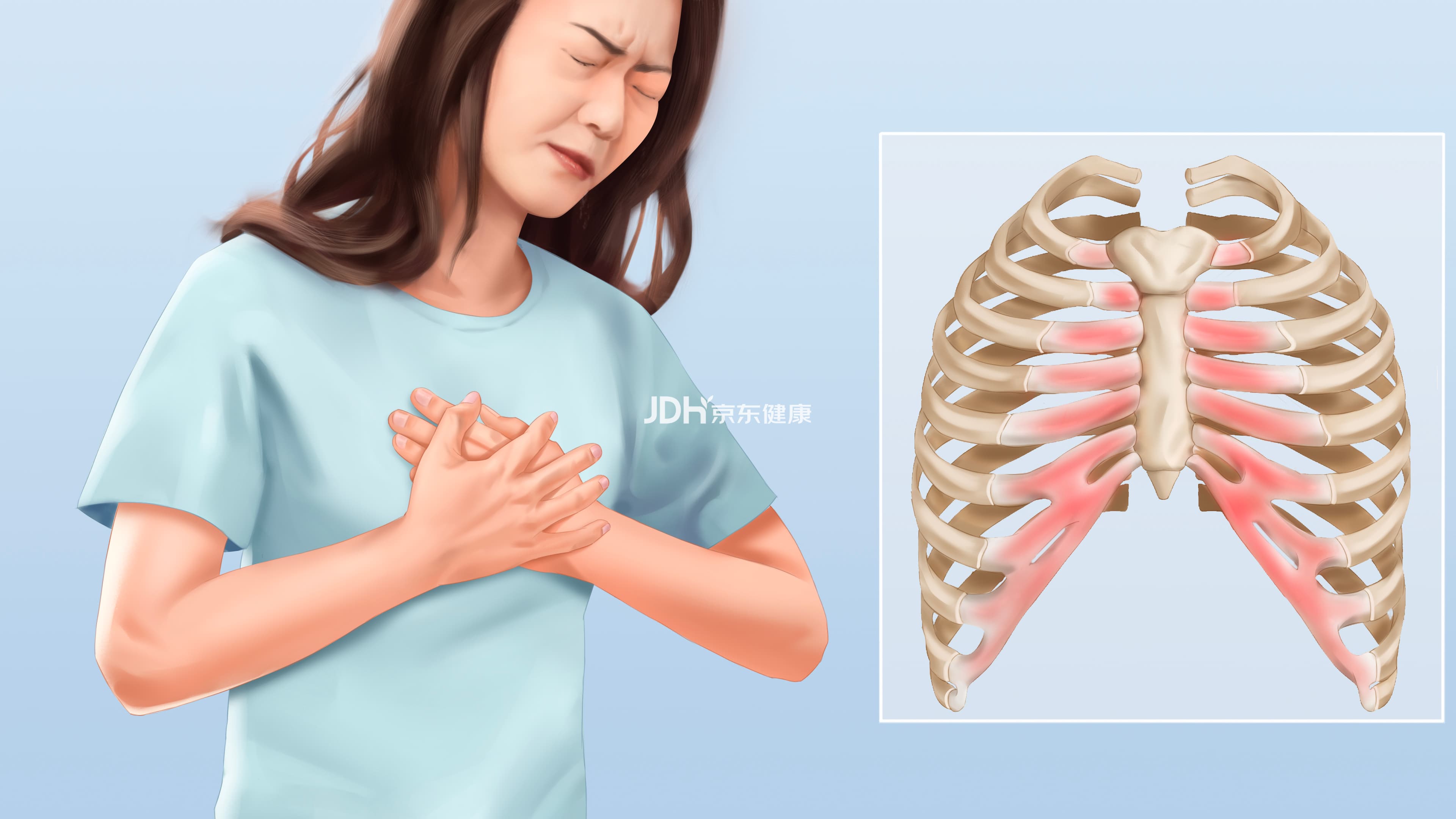 肋软骨炎：症状、诊断与治疗全解析