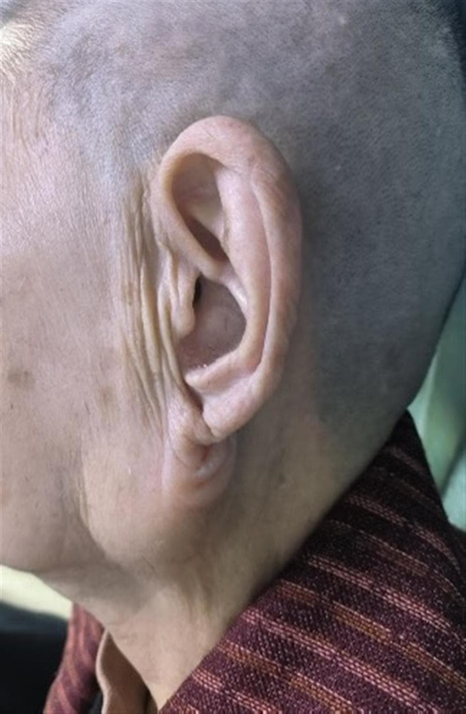 88岁婆婆长出鸡蛋大小腮腺肿瘤，医院多学科保驾护航顺利切除