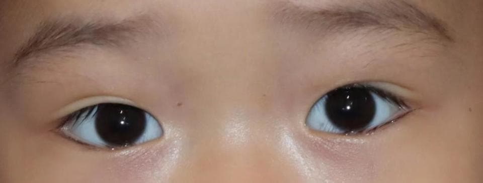 秋季警惕！儿童倒睫病例多发，眼科医生教你三招正确防治
