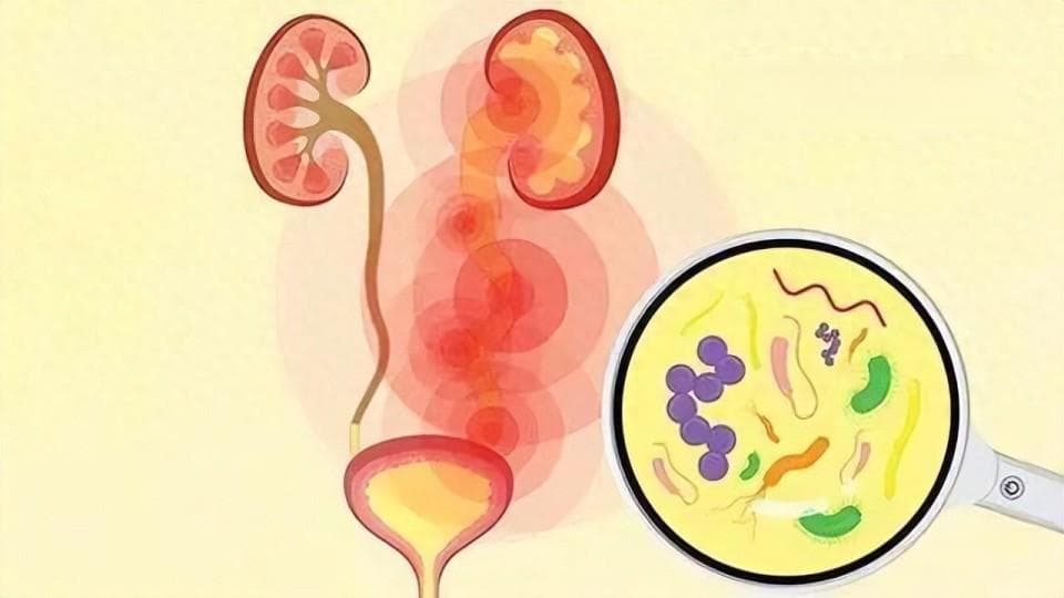 50%女性一生至少经历一次尿路感染，出现4类症状，及时就医
