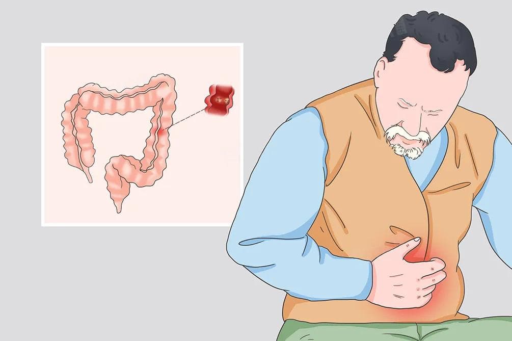 横结肠管状腺瘤是什么病