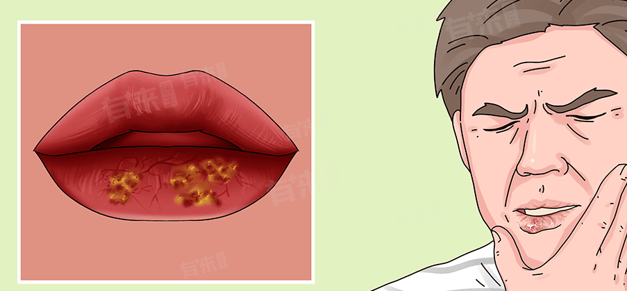 上嘴唇起了密密麻麻的小水泡怎么办？原因、检查与治疗全解析