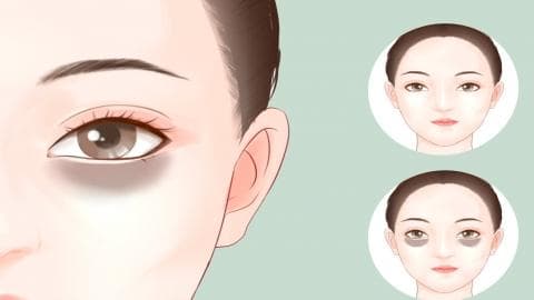 黑眼圈、眼袋很严重怎么办