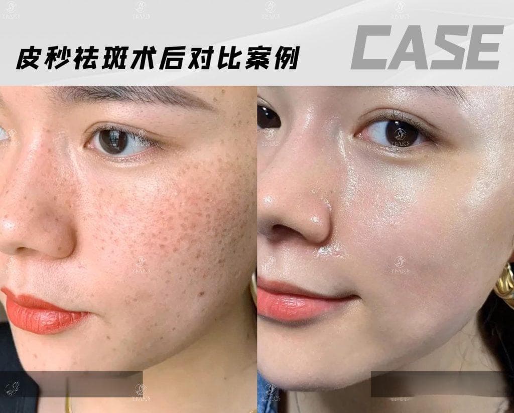 激光去斑的注意事项