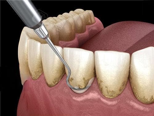 牙结石能被抠掉？重新认识牙结石与口腔健康的关系