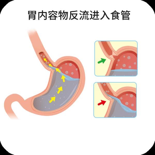 半夜胃反酸水是什么原因