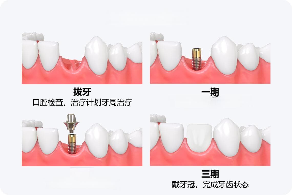 种植牙后多长时间可以运动