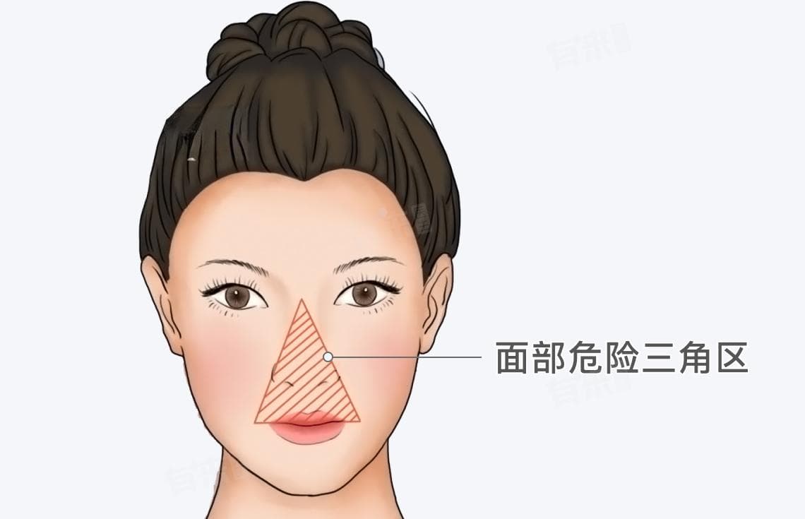 面部危险三角区：位置、结构特点及正确处理方法