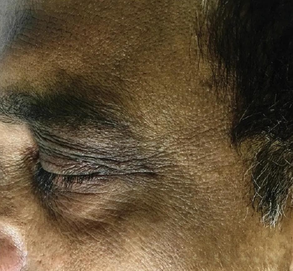 面部黑棘皮病：一种被严重低估的皮肤病！