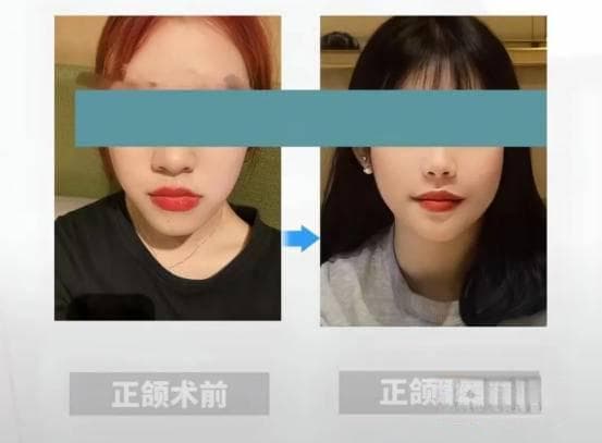 嘴凸、地包天、龅牙以及大小脸如何治？正颌、正畸还是正颌正畸联合诊疗，这里一次说透
