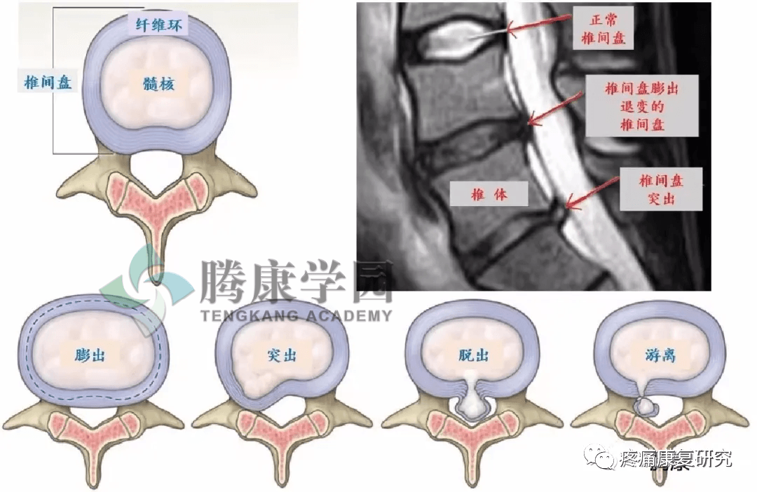 椎间盘突出症的类型、症状及体格检查