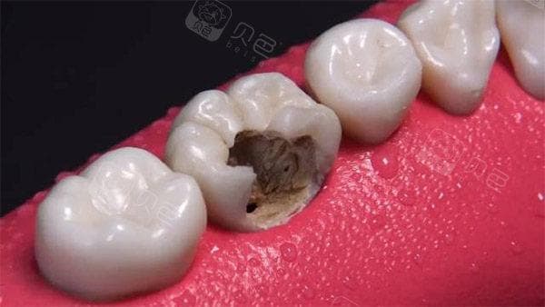 牙齿酸软无力咬不动东西怎么回事?有可能是龋齿/牙龈炎/牙周炎~及时就医是关键!