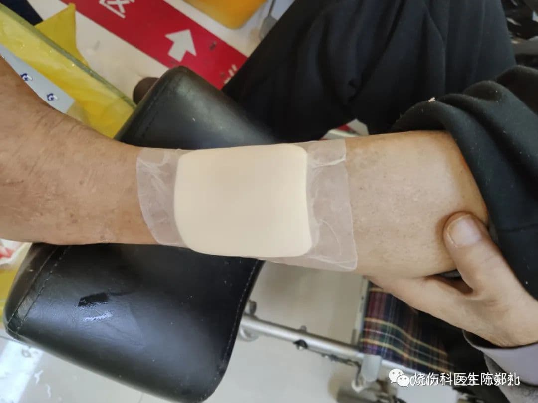 烫了水泡怎么办？专业医生详解轻度烫伤处理方法