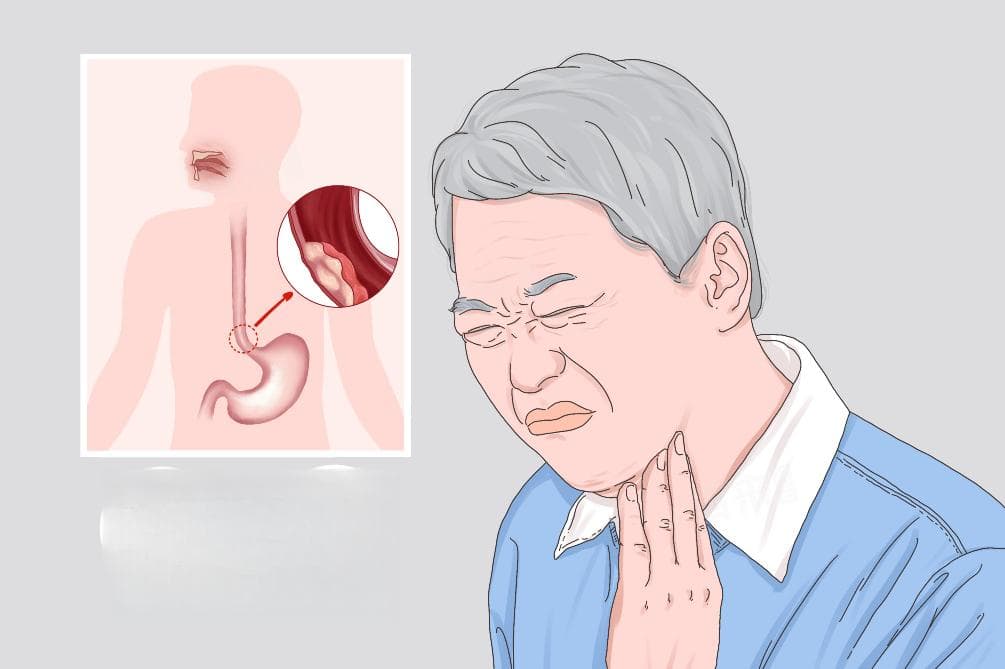 食道癌手术后能活几年？这些因素影响生存期