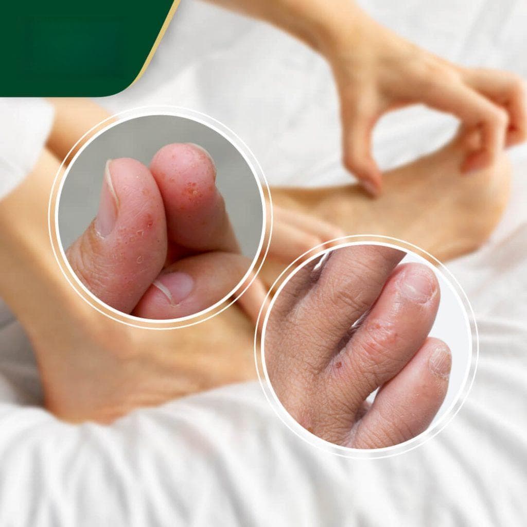 濕疹：【汗皰疹】會自己好嗎？初期症狀、舒緩及治療方法推薦全面睇。