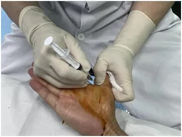 罗医疼痛科：一文教你看懂“腱鞘炎”