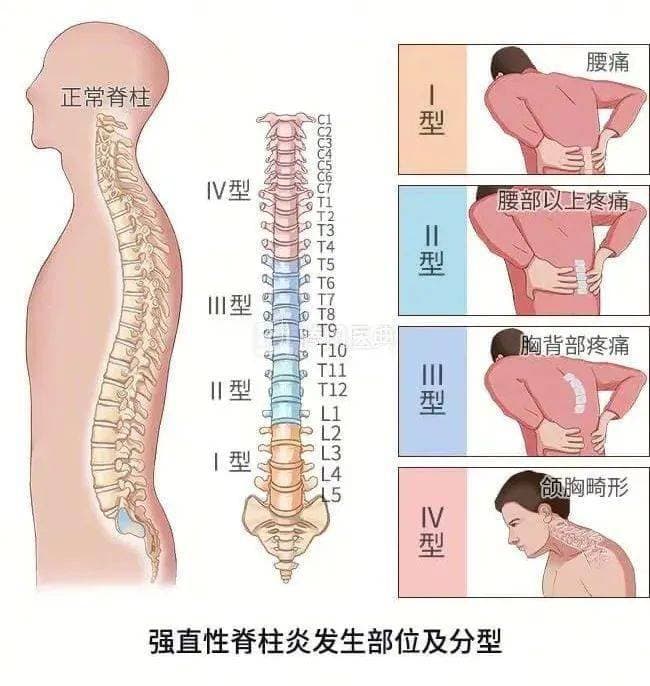 强直性脊柱炎：了解这种慢性炎症性疾病