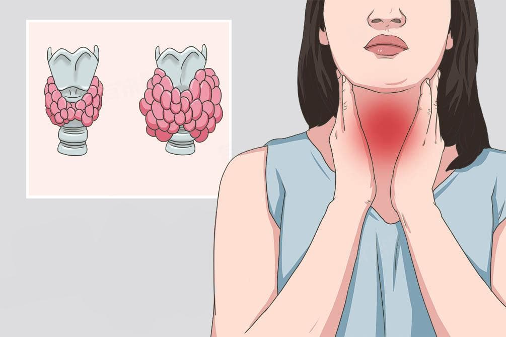 什么是桥本病？病因、症状及治疗方法全解析