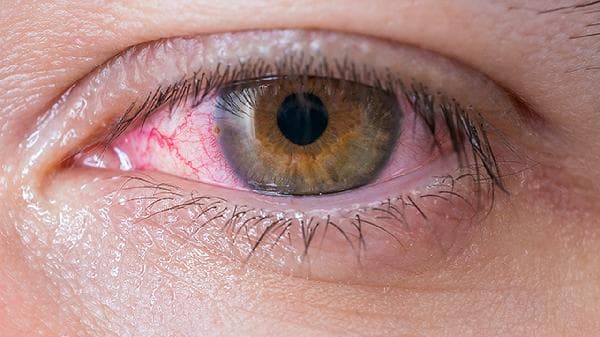 红眼病：如何正确选择眼药水